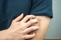 punaises de lits 