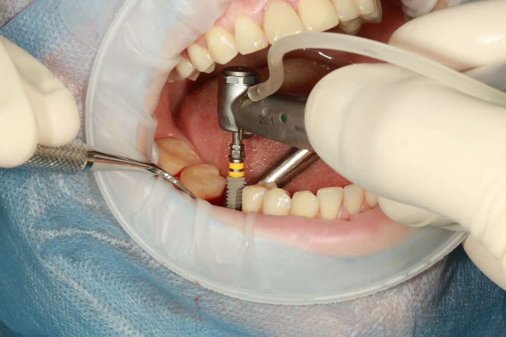 sont les avantages des implants dentaires